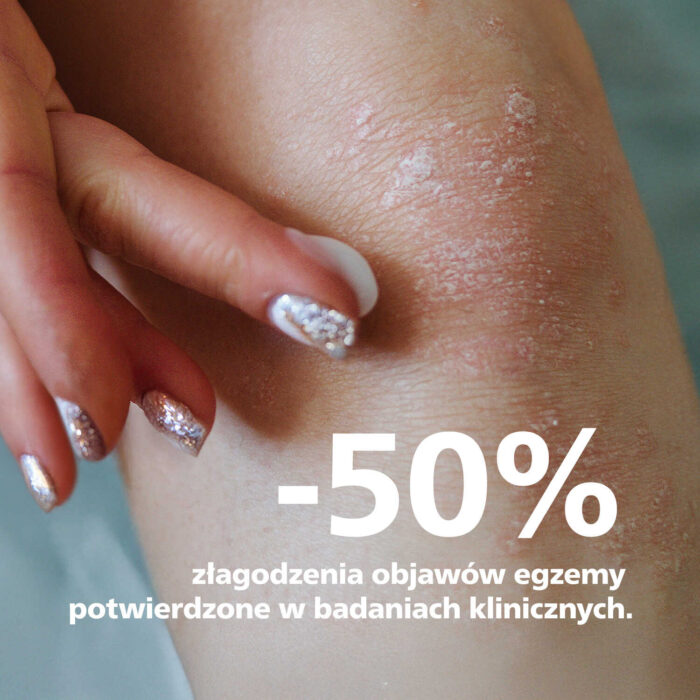 Redukcja objawów egzemy potwierdzona klinicznie.